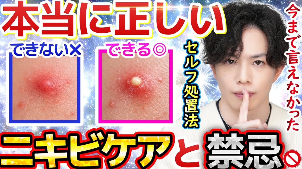 【ニキビのセルフ処置法】『正しく潰す』コツと使用器具を初解説！SNSで波紋のニキビ問題について